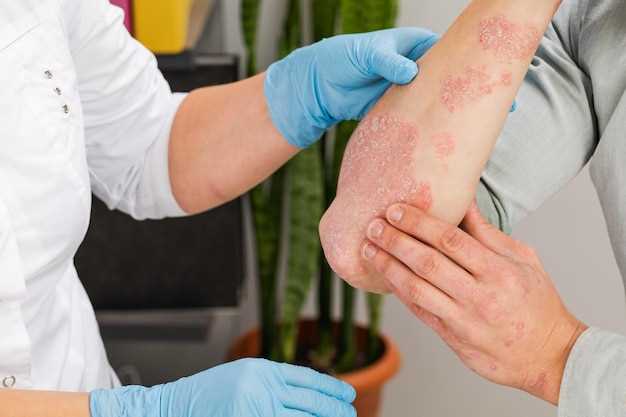 Как проводится лечение аллергического контактного дерматита и какие могут быть последствия?
