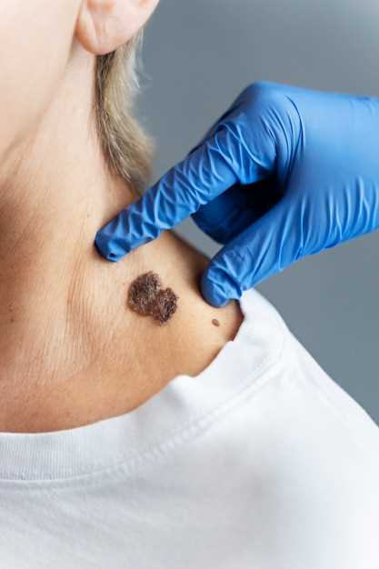 Лечение вирусных опухолей кожи у женщин