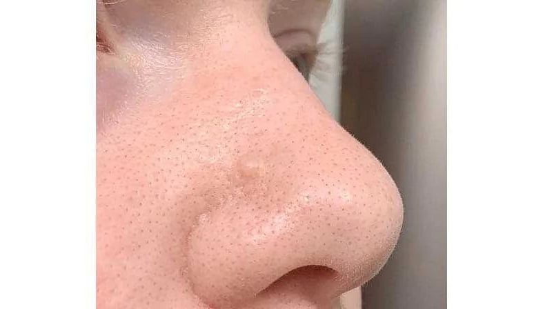 Causes of a Pimple Under the Nose