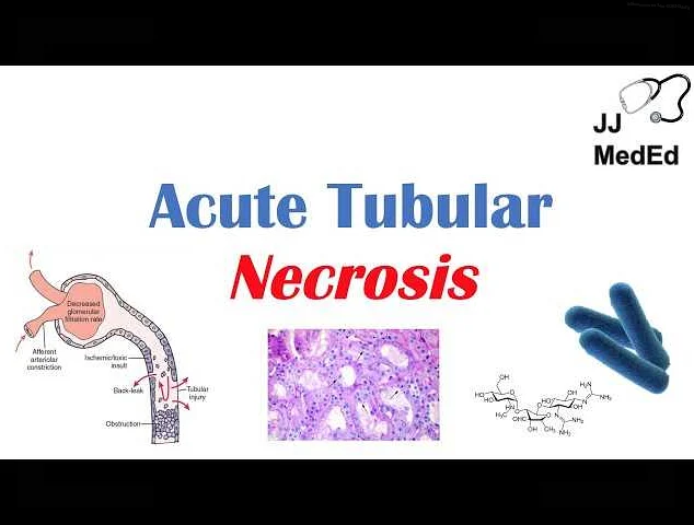 Symptoms of Acute Tubular Necrosis (ATN)