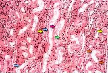 Diagnosis of Acute Tubular Necrosis (ATN)