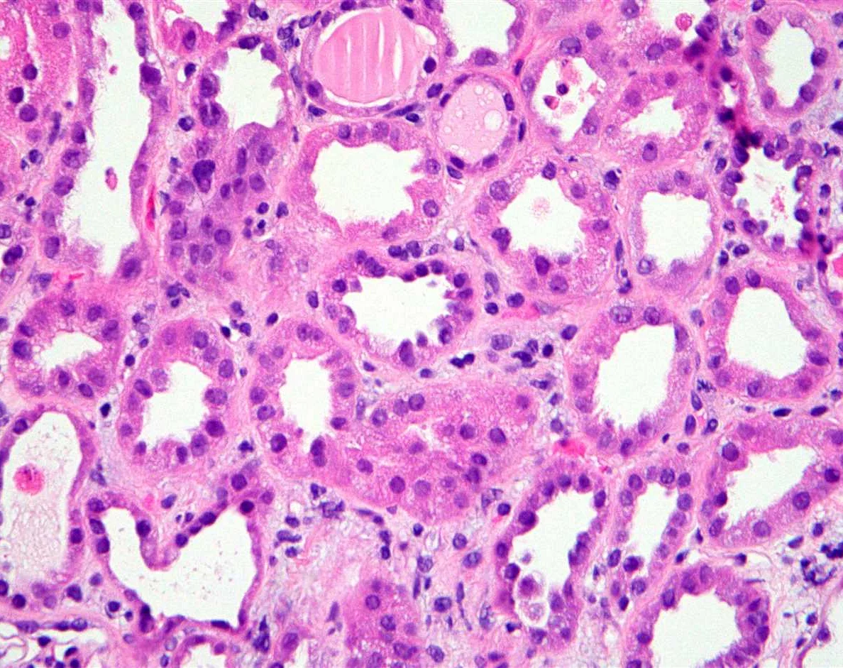 Causes of Acute Tubular Necrosis (ATN)