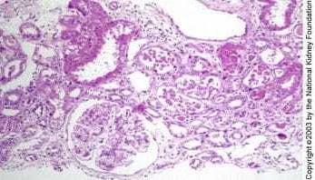 Treatment for Acute Tubular Necrosis (ATN)