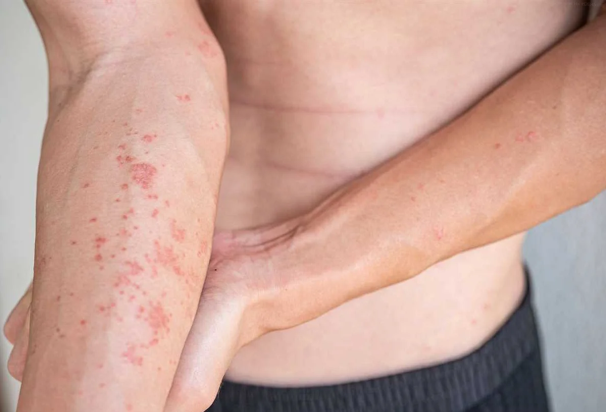 Understanding Allergic Dermatitis