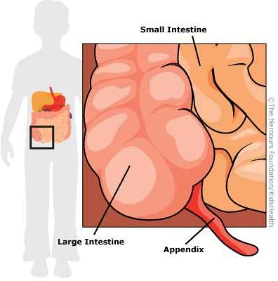 Overview of Appendicitis