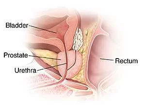 Types of Bacterial Prostatitis