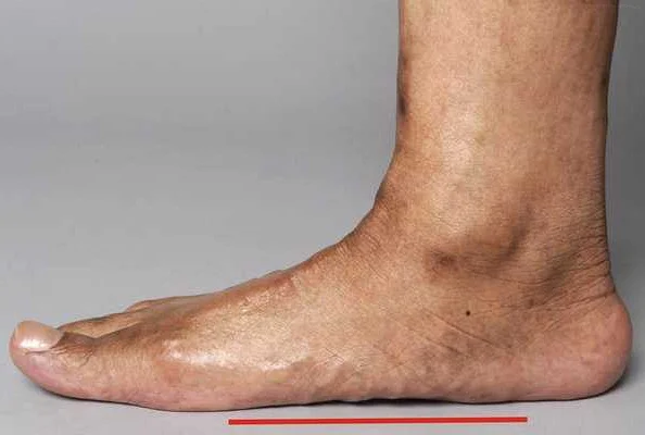 Orthotic Devices for Flat Feet: Finding the Right Fit