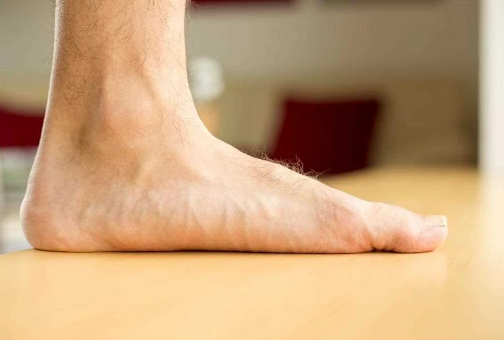 Understanding Flat Feet and Treatment Options