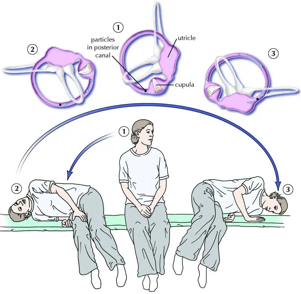 Overview of Benign Paroxysmal Positional Vertigo