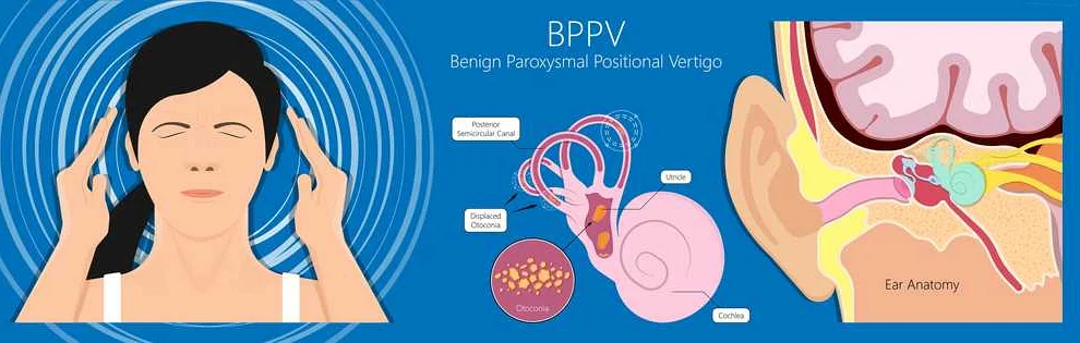 Common Symptoms of Benign Paroxysmal Positional Vertigo