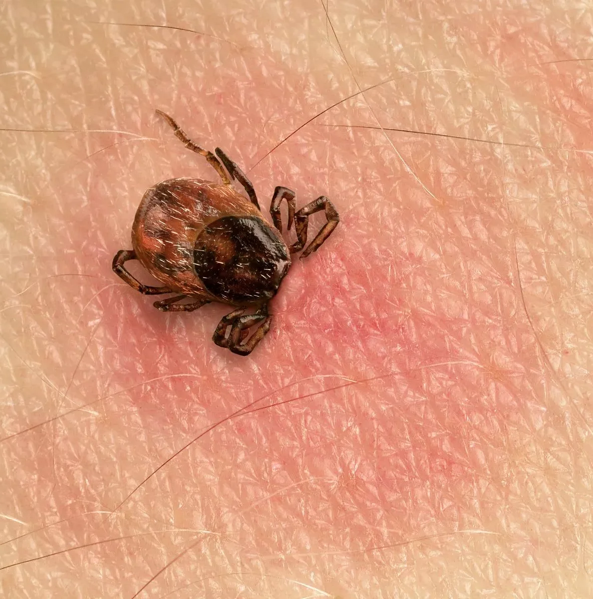 Tick-Borne Encephalitis