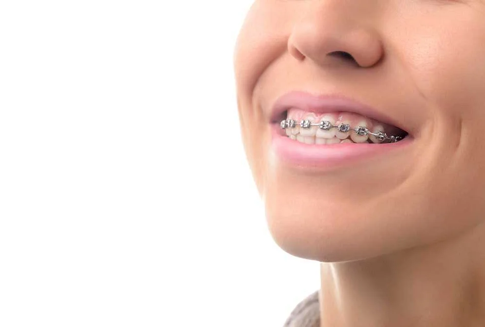 The Importance of Braces for Teenagers