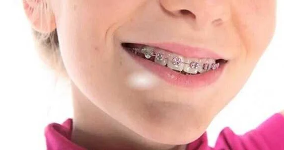 Benefits of Braces for Teenagers