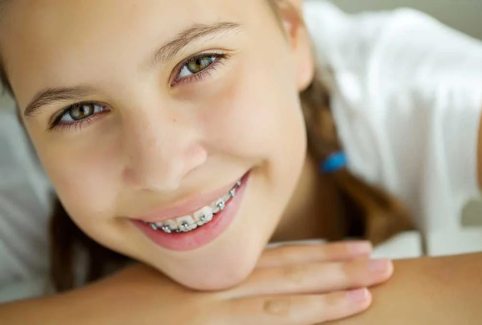 Considerations for Braces Usage