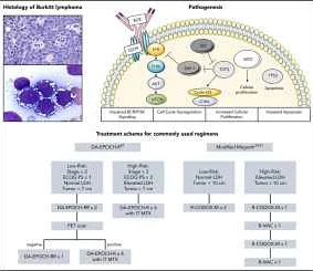 Understanding the Different Stages of Burkitt's Lymphoma