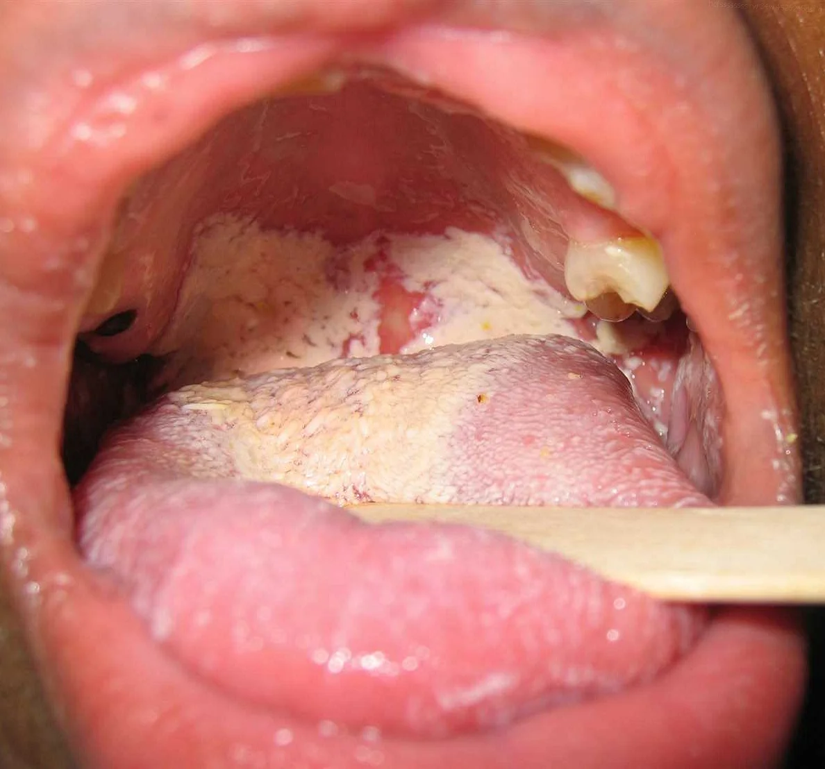 What is Candidiasis?