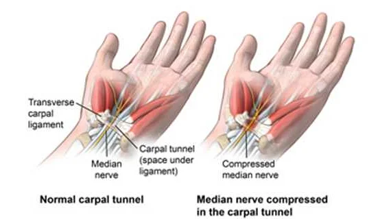 Understanding Carpal Tunnel Syndrome