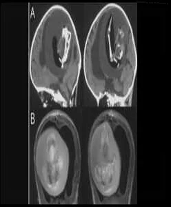 Chinese doctors successfully remove parasitic twin from girl's brain