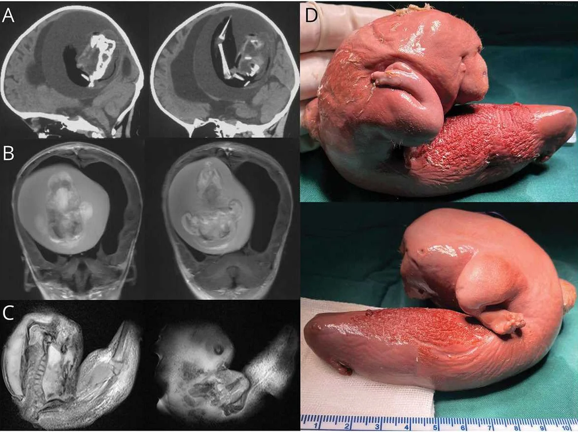 Parasitic twin discovered during routine check-up