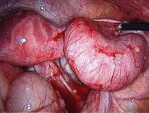 Common Causes of Chronic Salpingoophoritis