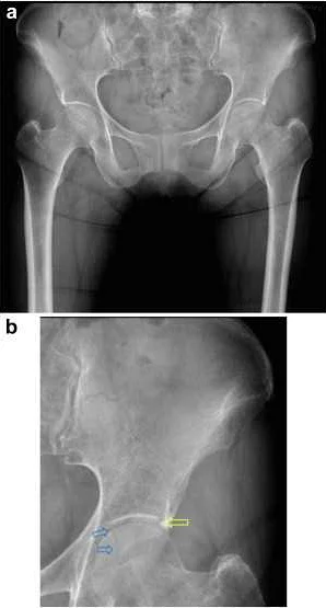 Intra-articular injections