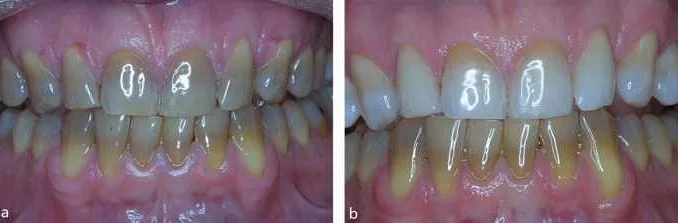 Dentist Ganiev explains: What is a tetracycline tooth and how to treat it?