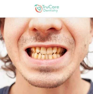 Understanding tetracycline tooth stains