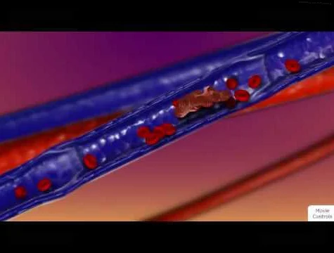 Factors Influencing Blood Clot Formation