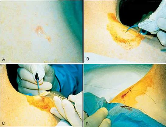 Effectiveness of Electrocoagulation in Papilloma Treatment