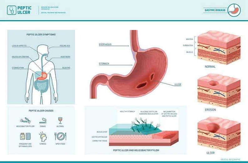 Common Symptoms of Gastritis