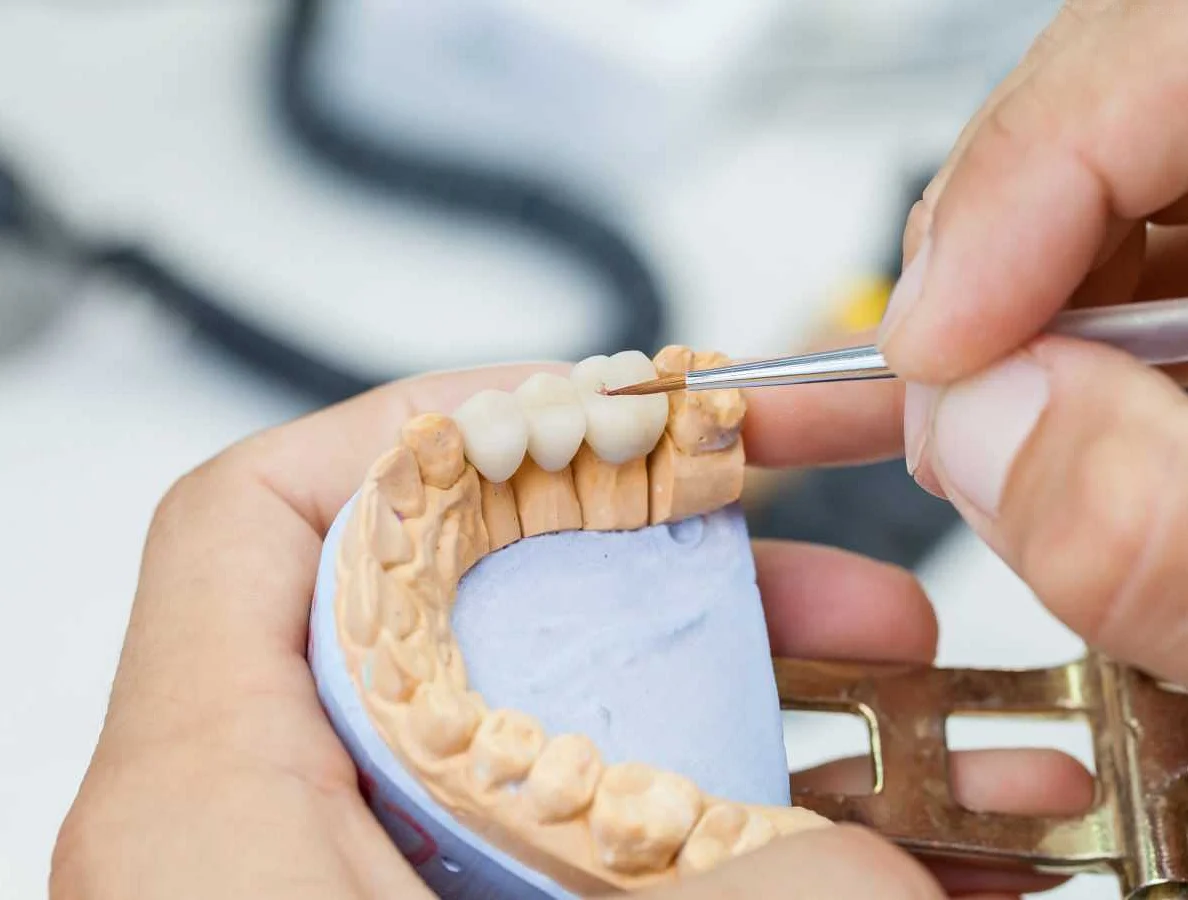 The Benefits of Fixed Dental Prosthetics