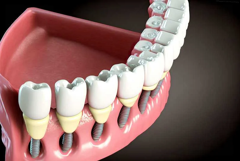 The Procedure for Getting Fixed Dental Prosthetics