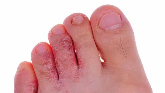 Identifying Foot Fungus Symptoms