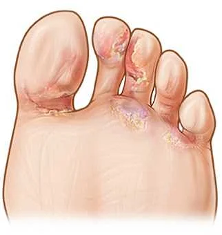 Understanding Foot Fungus