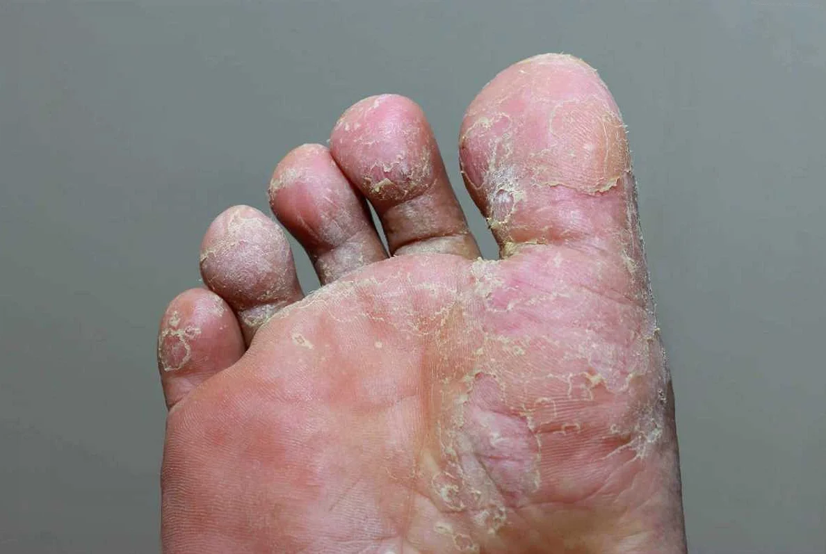 Preventing Foot Fungus Infection