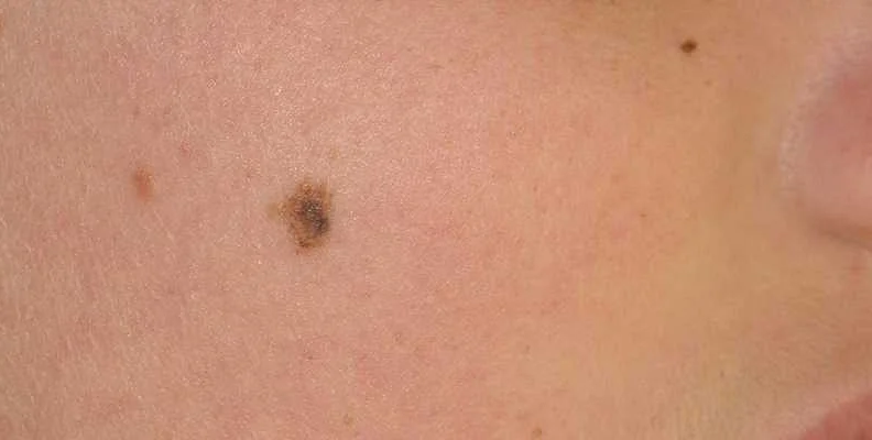 The Intriguing Process of Mole Transformation into Melanoma