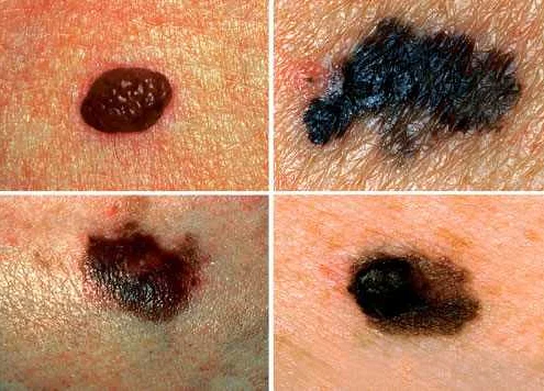Recognizing the Warning Signs of Mole Transformation
