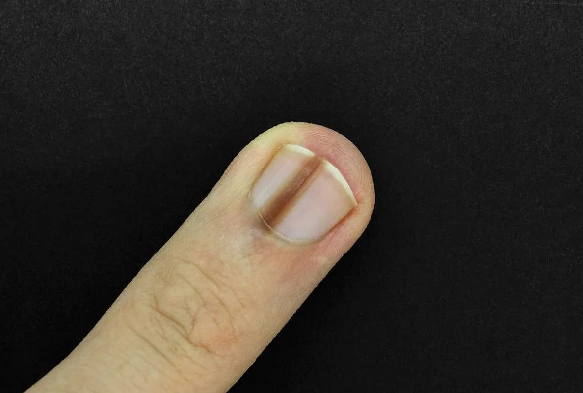 Genetic Studies Linking Gel Polish Manicure to Cancer Risk