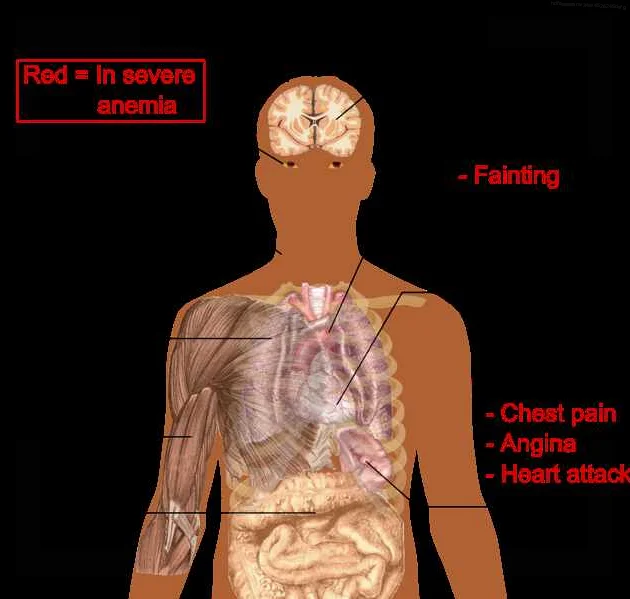 Understanding the Symptoms of Harmless Anemia