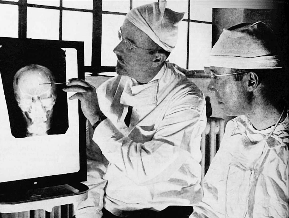 Lobotomy: Surgical Destruction of the Brain