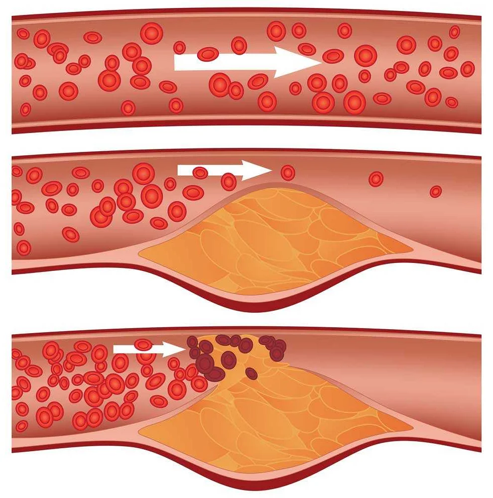 Understanding Plaque Formation