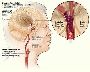 Key Risk Factors for Cerebral Atherosclerosis