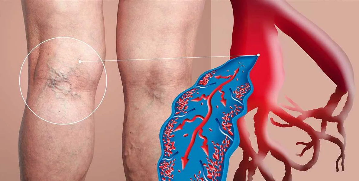 Understanding Thrombosis