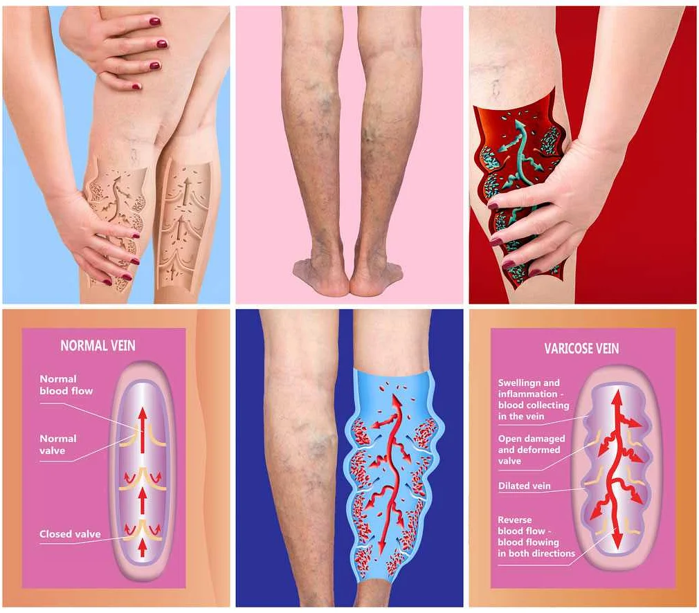 Common Causes of Thrombosis