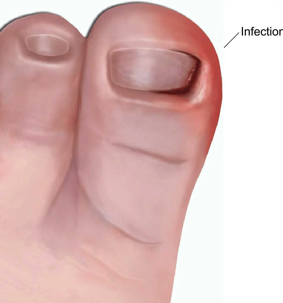 The Role of Toenail Trimming in Overall Foot Health