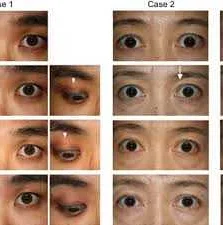 Causes of Eyelid Inflammation