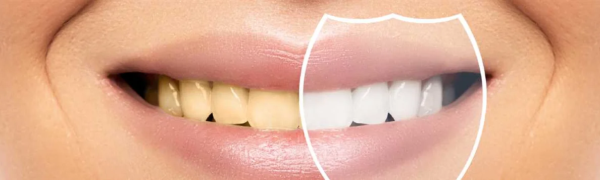 Dispelling the Misconception of Yellow Teeth as a Sign of Weakness