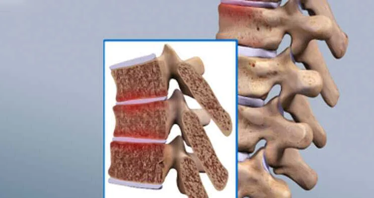 Symptoms of Juvenile Osteochondrosis