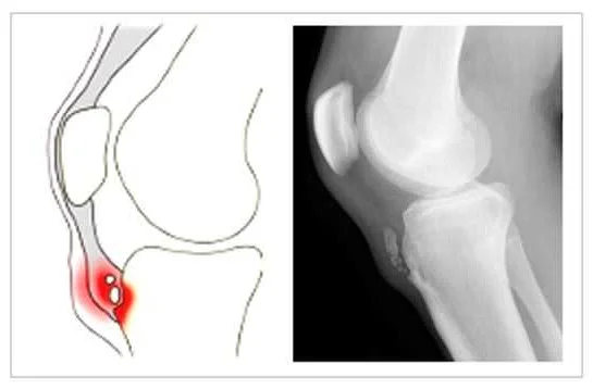 Preventive Measures for Juvenile Osteochondrosis