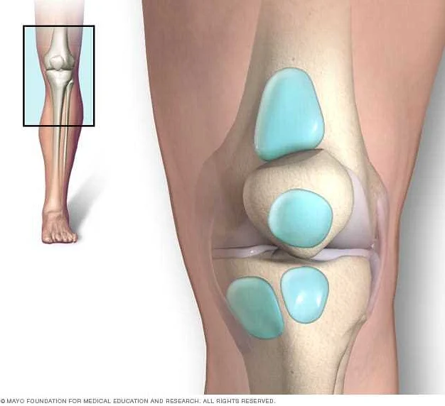 Diagnosis of Knee Bursitis